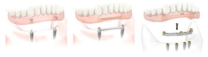 implantatgetragener Zahnersatz