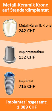 Was ist ein Zahnimplantat? Und Zahnimplantate Kosten Was ist ein Zahnimplantat