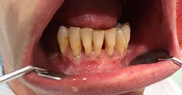 Kranke Zähne