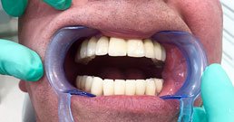 Implantat zahn erfahrung