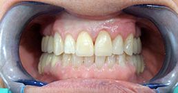 Veneers in Ungarn Erfahrung veneers ungarn erfahrung