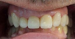 Zähne überkronen vorher und nachher