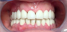 Zahnverfärbung nach Behandlung